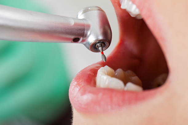 Best Emergency Root Canal Treatment in Quincy, MI